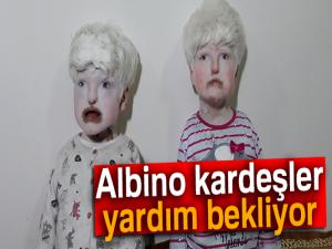 Albino kardeşler yardım bekliyor | Albino hastalığı nedir?